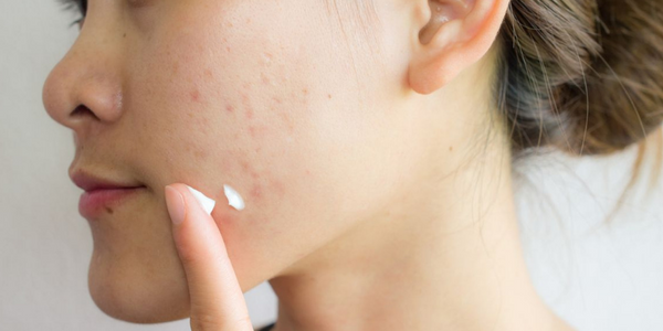 Best Skin Care Products For Acne Scars
