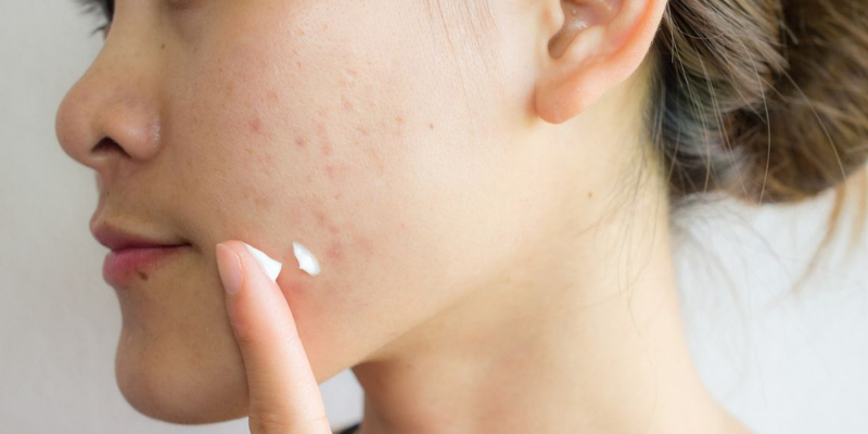 Best Skin Care Products For Acne Scars