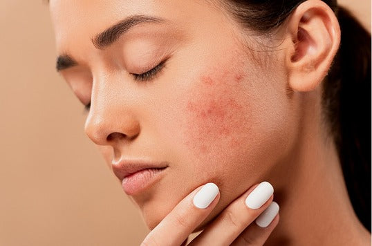 Anti Blemish Skin Care Products