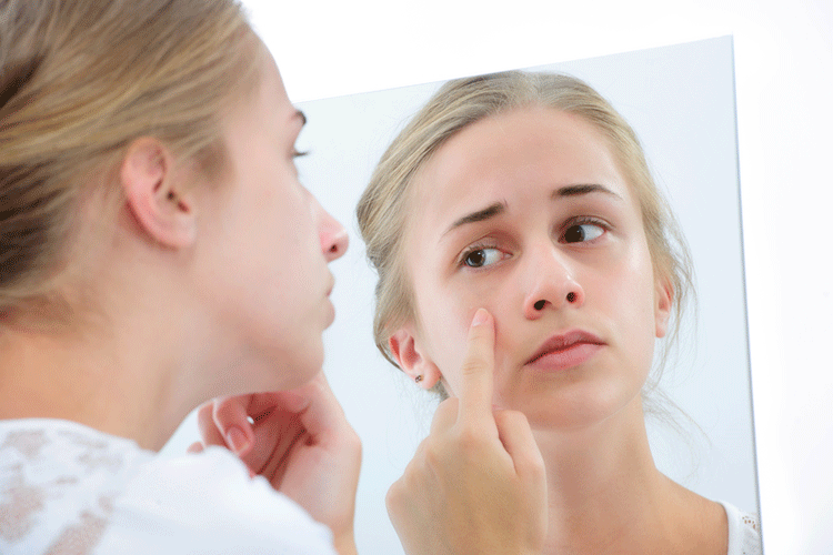 Best Acne Treatment