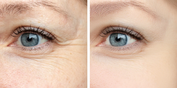 Eye Wrinkles Treatment