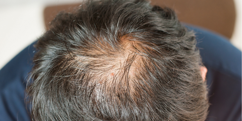 Can Vitamin Deficiency Cause Hair Loss And Can You Solve It With Hair Loss Vitamin?