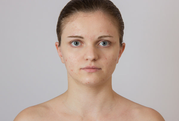 Best Skin Care Products For Hormonal Acne