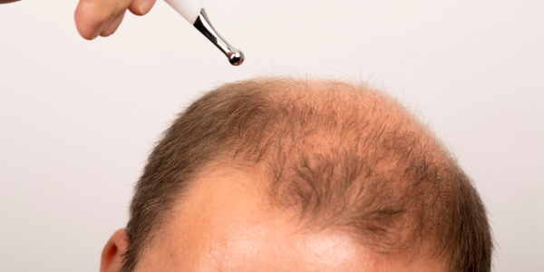Does Low Vitamin D Cause Hair Loss And Is Hair Loss Vitamin A Solution?