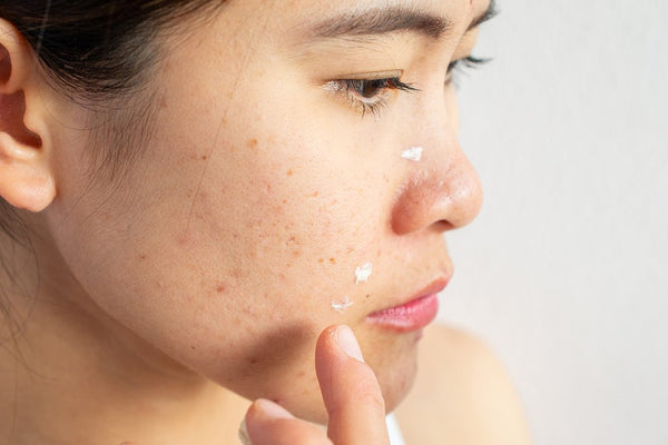Best Skin Care Products For Acne