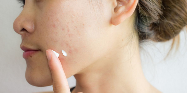 Best Skin Care Products For Acne Scars