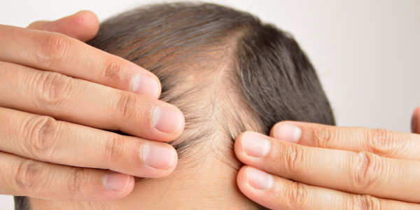 What Vitamins Are Good For Hair Loss? Hair Loss Vitamin Will Solve Hair Loss!